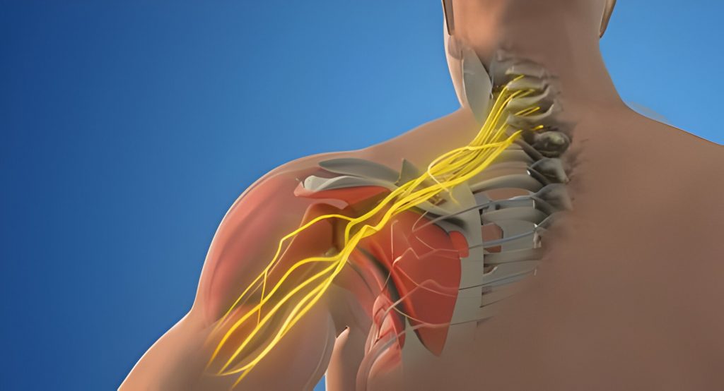 plexus brachial